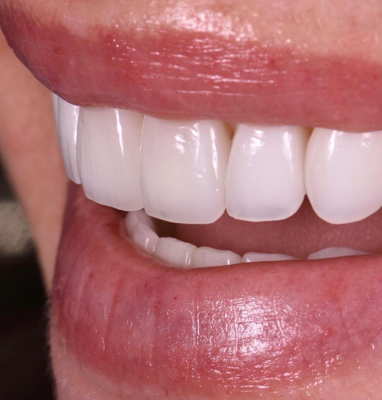 Ortodoncia invisible: estética y funcionalidad en un solo tratamiento