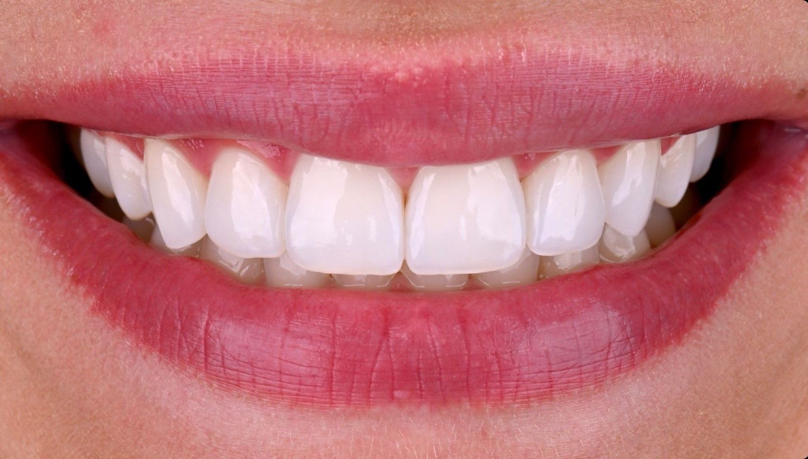 Diseño de sonrisa digital (DSD): la revolución estética en odontología