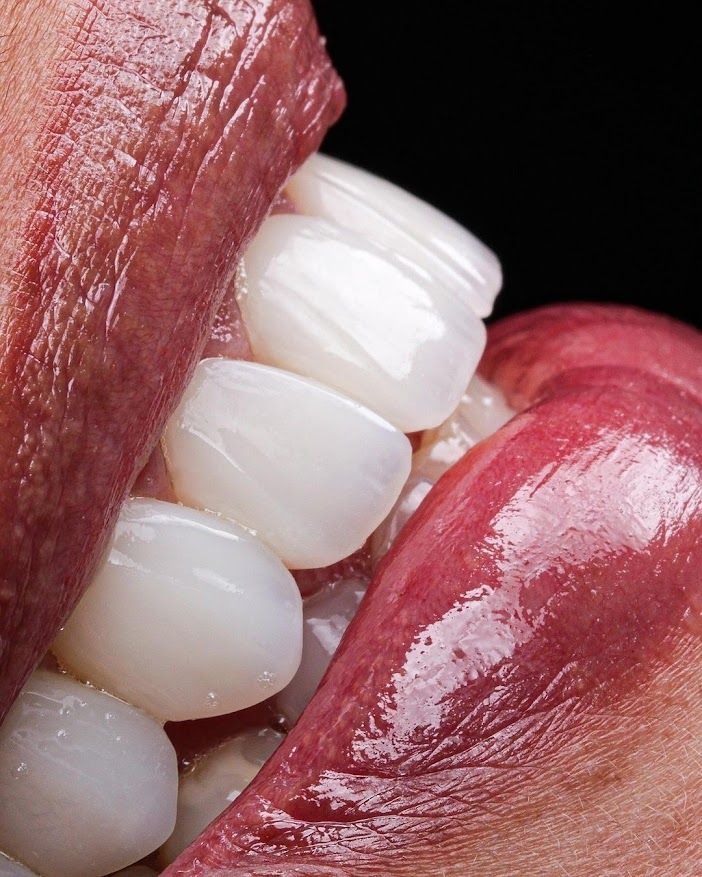Rehabilitación estética con resinas compuestas: casos y técnica